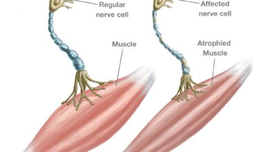 What causes ALS? Scientists still seek answers