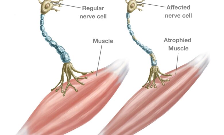 What causes ALS? Scientists still seek answers